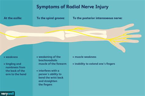 symptoms of radial nerve entrapment